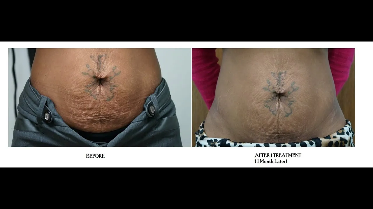 Skin Tightening (Loose Skin)