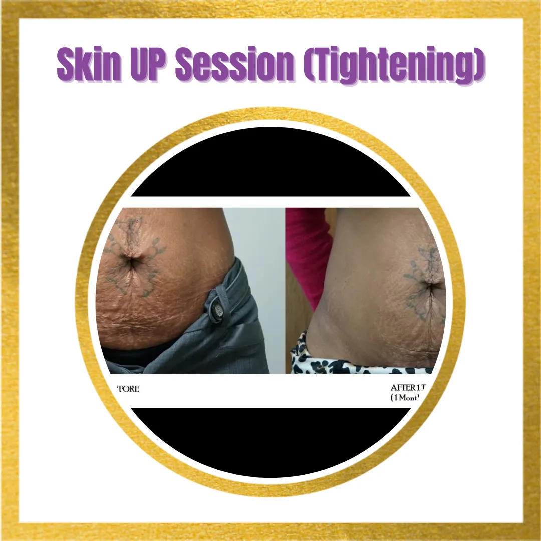 Skin Tightening (Loose Skin)