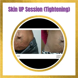 Skin Tightening (Loose Skin)